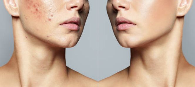 Before &After